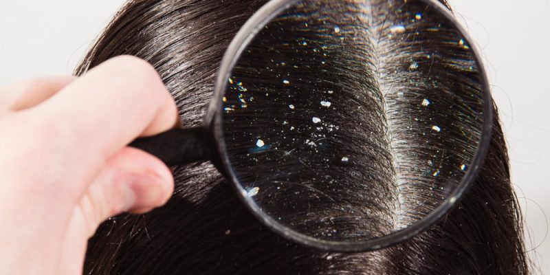 doctor-looks-through-magnifying-glass-dandruff-dark-female-hair